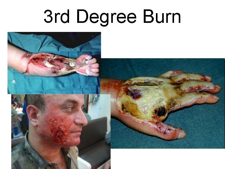 3 rd Degree Burn 