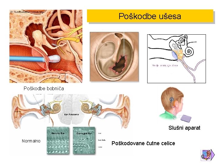 Poškodbe ušesa Poškodbe bobniča Slušni aparat Normalno Poškodovane čutne celice 