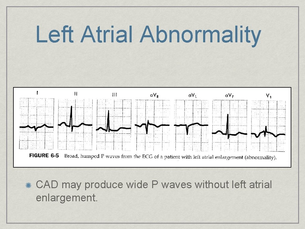 Left Atrial Abnormality CAD may produce wide P waves without left atrial enlargement. 