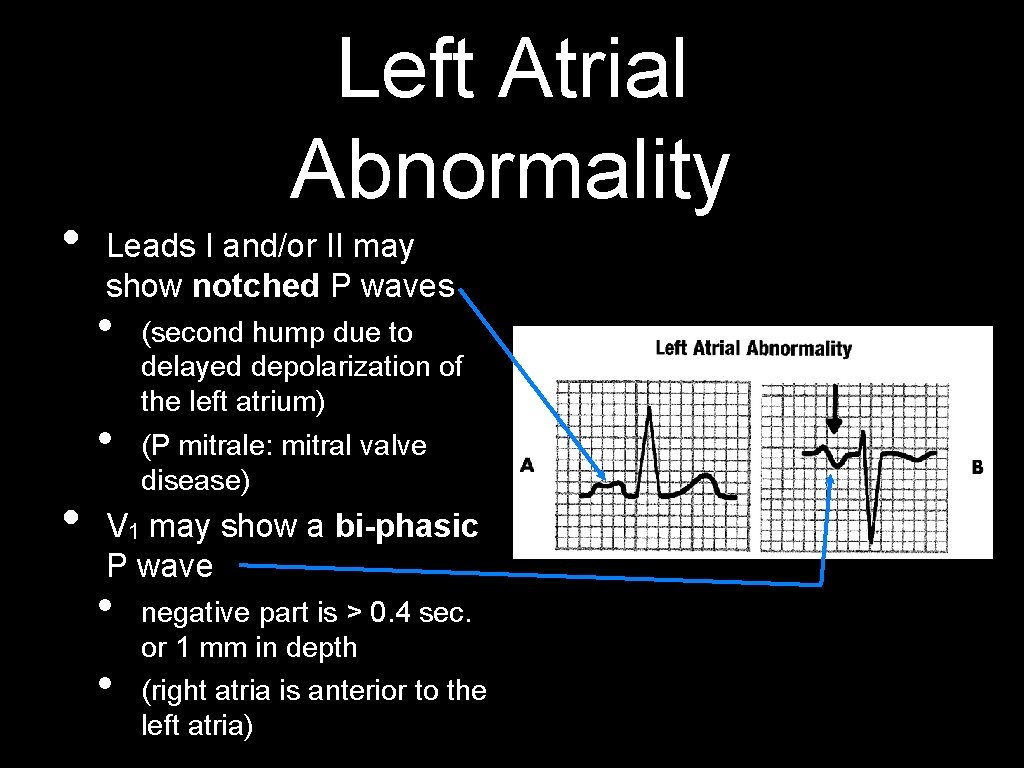  • Left Atrial Abnormality Leads I and/or II may show notched P waves