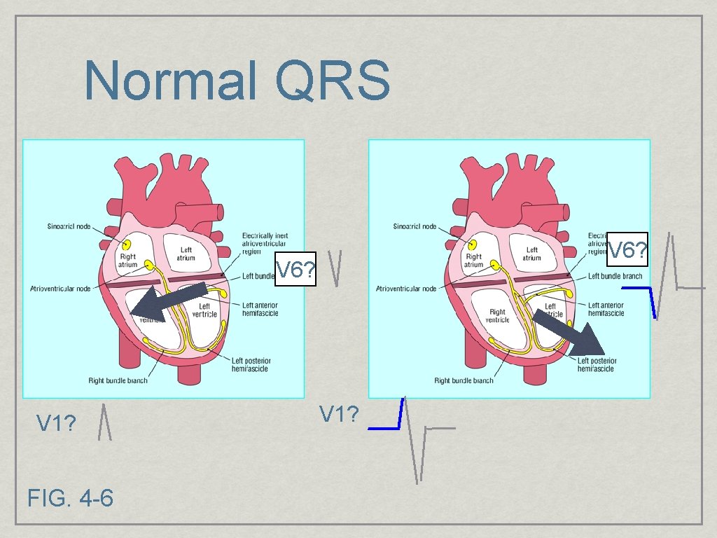 Normal QRS V 6? V 1? FIG. 4 -6 V 1? 