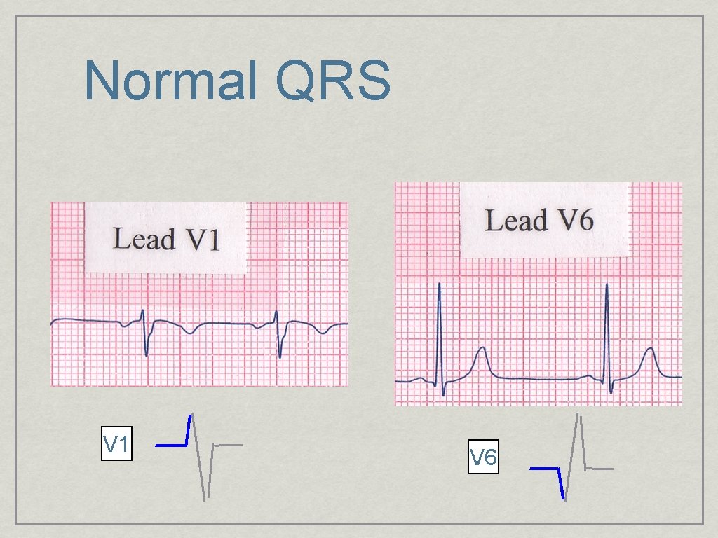 Normal QRS V 1 V 6 