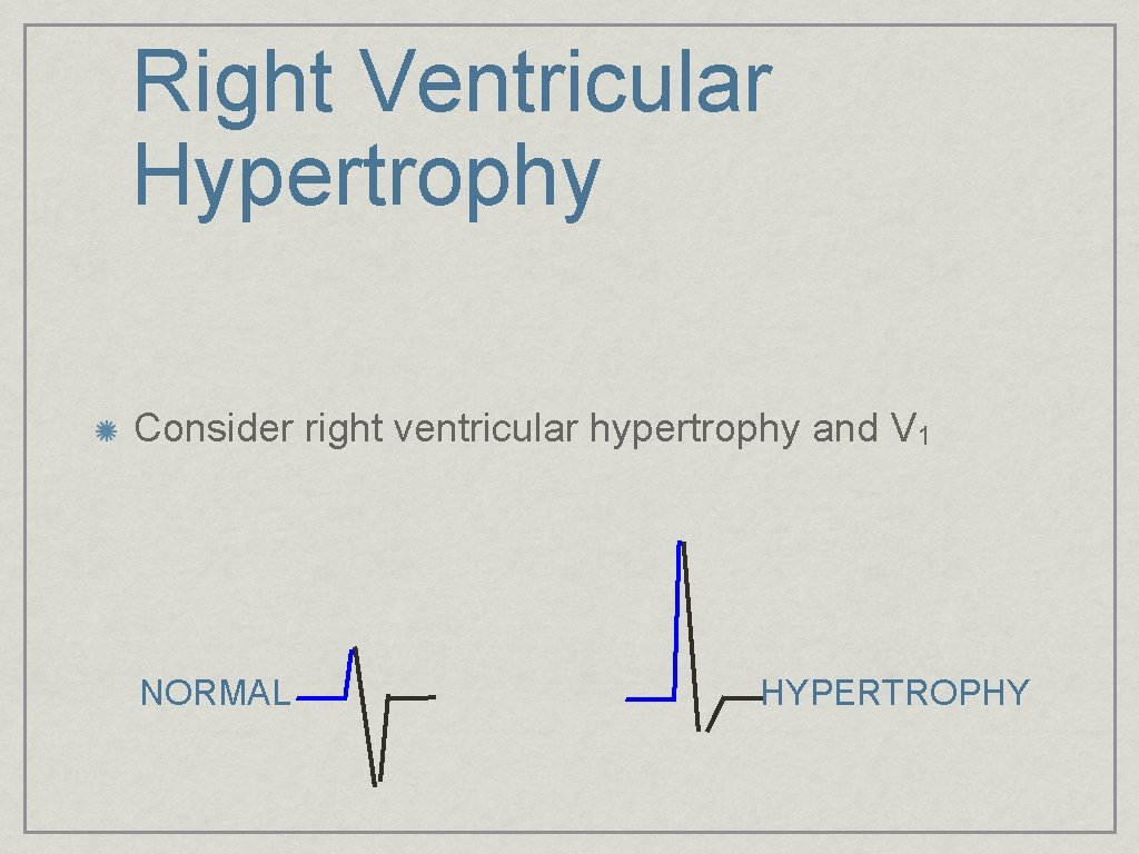 Right Ventricular Hypertrophy Consider right ventricular hypertrophy and V 1 NORMAL HYPERTROPHY 