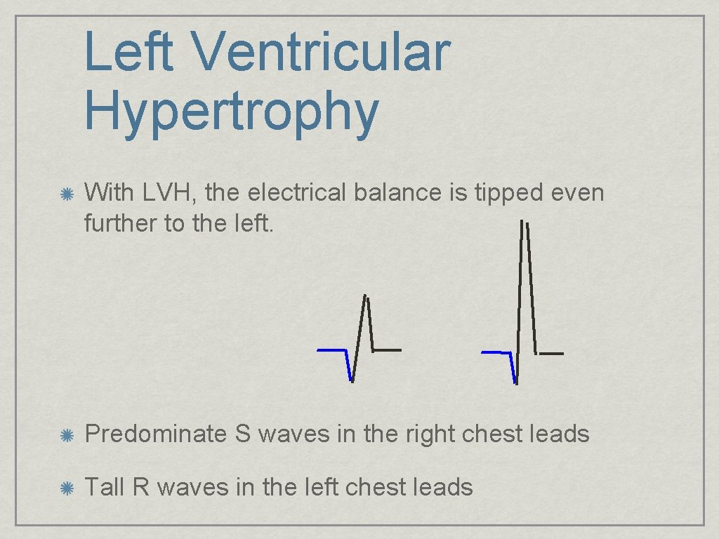 Left Ventricular Hypertrophy With LVH, the electrical balance is tipped even further to the