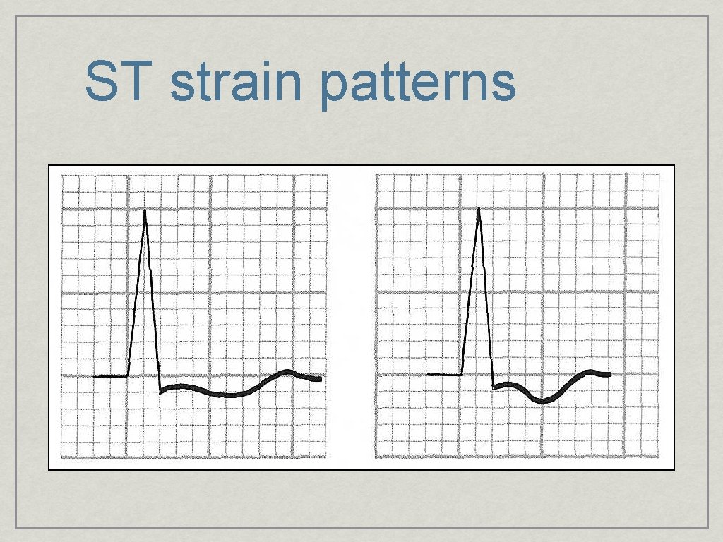 ST strain patterns 