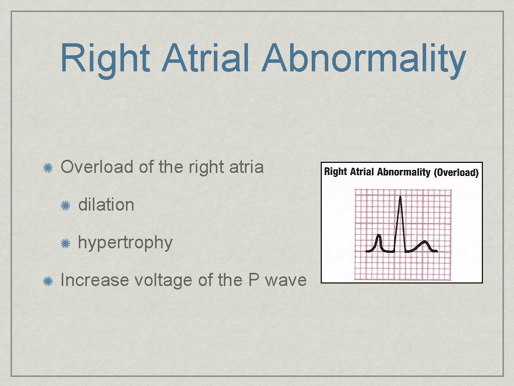 Right Atrial Abnormality Overload of the right atria dilation hypertrophy Increase voltage of the