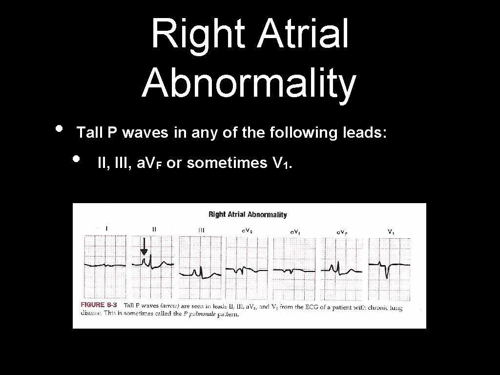 Right Atrial Abnormality • Tall P waves in any of the following leads: •