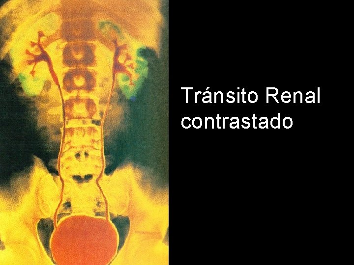 Tránsito Renal contrastado 