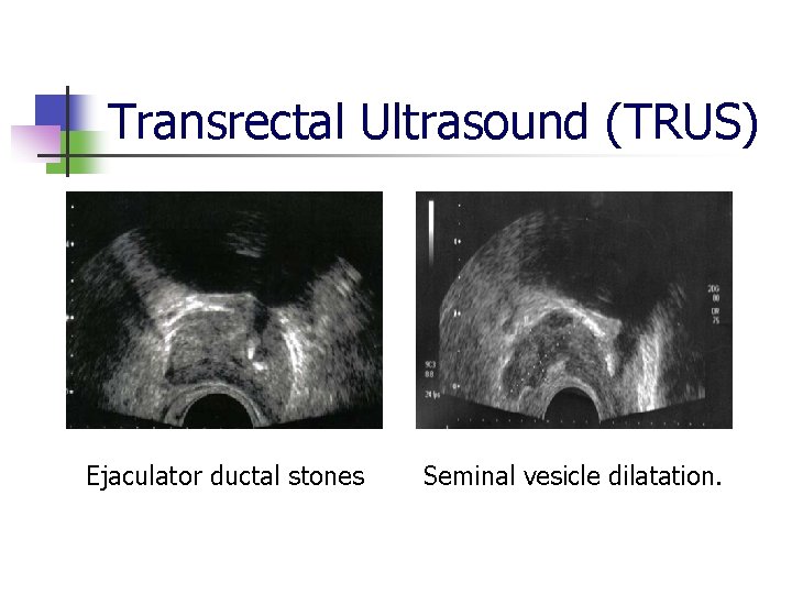 Transrectal Ultrasound (TRUS) Ejaculator ductal stones Seminal vesicle dilatation. 