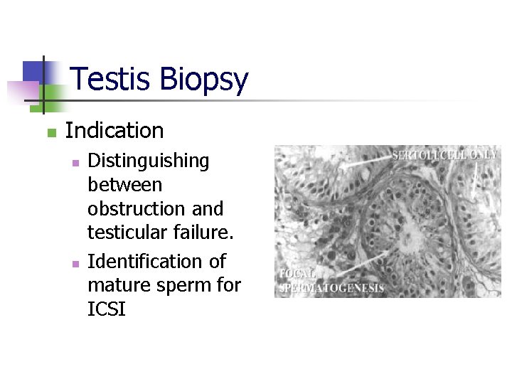 Testis Biopsy n Indication n n Distinguishing between obstruction and testicular failure. Identification of