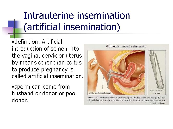 Intrauterine insemination (artificial insemination) • definition: Artificial introduction of semen into the vagina, cervix