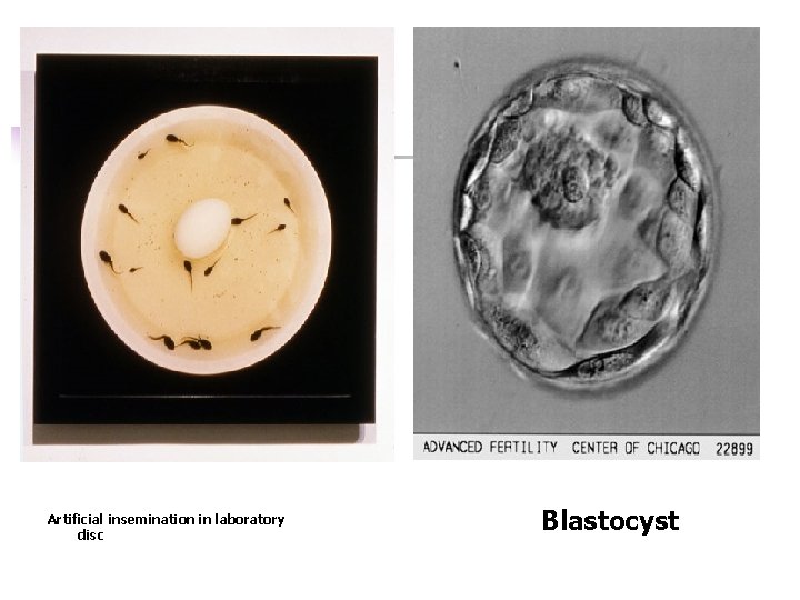 Artificial insemination in laboratory disc Blastocyst 
