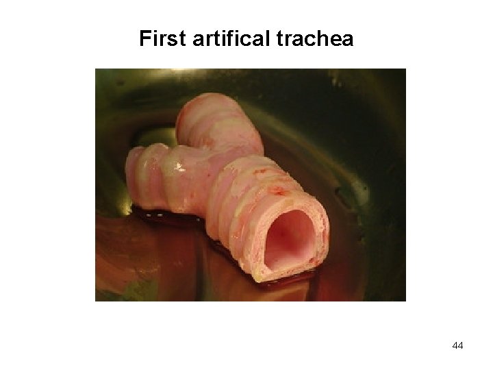 First artifical trachea 44 
