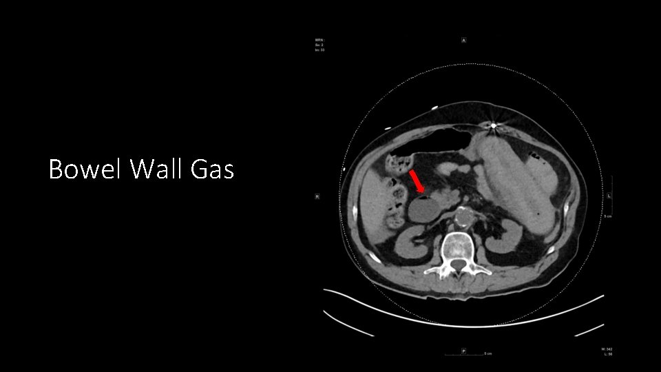 Bowel Wall Gas 