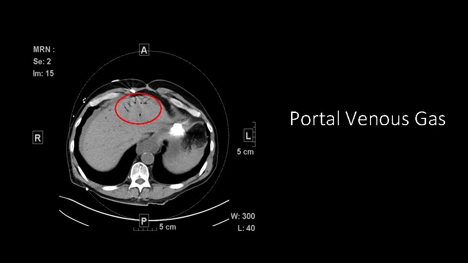 Portal Venous Gas 