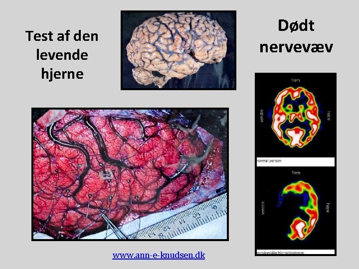 Dødt nervevæv Test af den levende hjerne www. ann-e-knudsen. dk 
