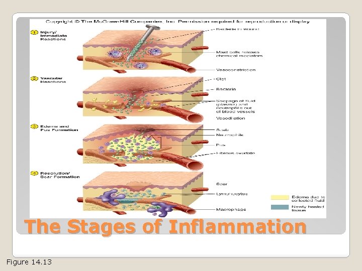 The Stages of Inflammation Figure 14. 13 