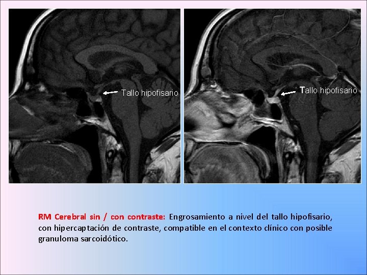 Tallo hipofisario RM Cerebral sin / contraste: Engrosamiento a nivel del tallo hipofisario, con