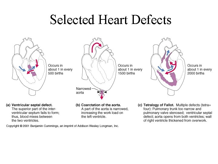 Selected Heart Defects 