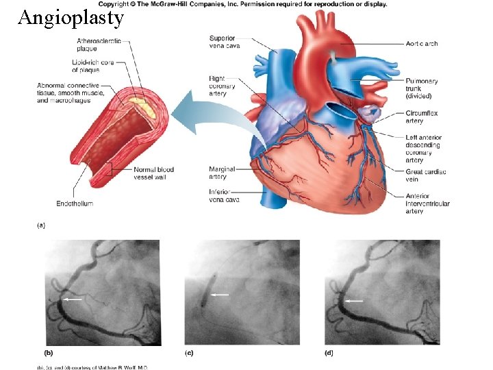 Angioplasty Fig. 12. 66 