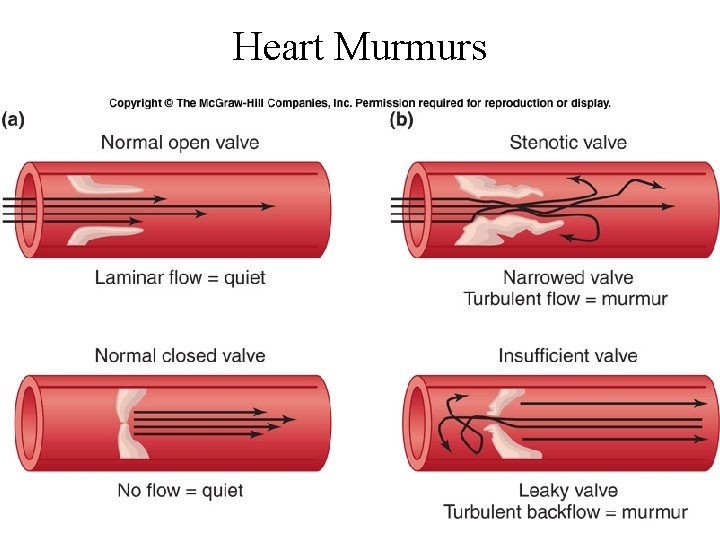 Heart Murmurs 