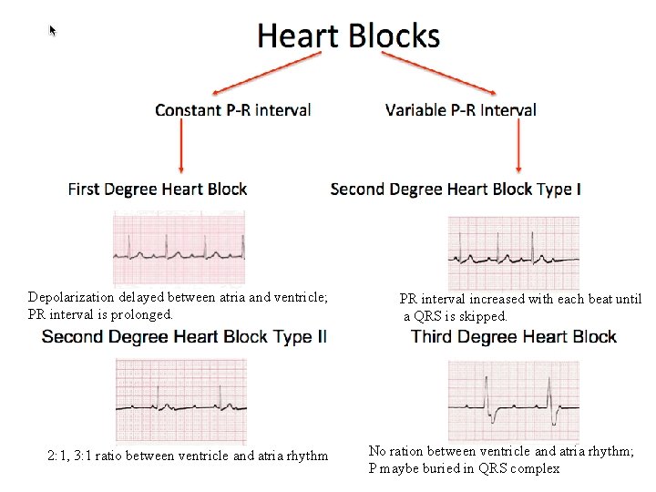 Depolarization delayed between atria and ventricle; PR interval is prolonged. 2: 1, 3: 1