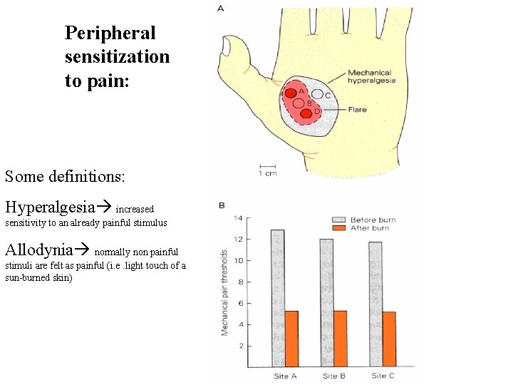 Peripheral sensitization to pain: Some definitions: Hyperalgesia increased sensitivity to an already painful stimulus