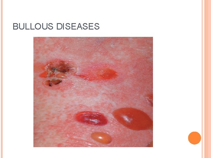 BULLOUS DISEASES 