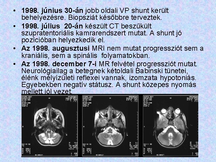  • 1998. június 30 -án jobb oldali VP shunt került behelyezésre. Biopsziát későbbre