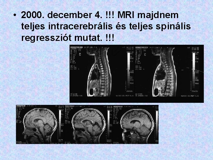  • 2000. december 4. !!! MRI majdnem teljes intracerebrális és teljes spinális regressziót