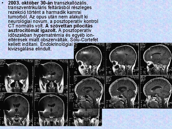  • 2003. október 30 -án transzkallózális, transzventrikuláris feltárásból részleges rezekció történt a harmadik