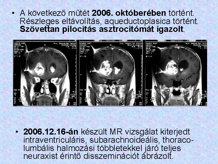  • A következő műtét 2006. októberében történt. Részleges eltávolítás, aqueductoplasica történt. Szövettan pilocitás