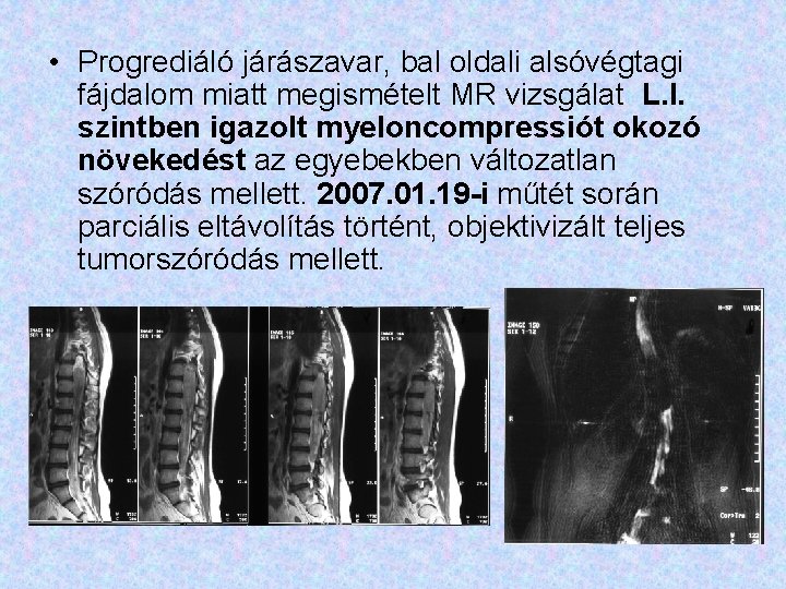  • Progrediáló járászavar, bal oldali alsóvégtagi fájdalom miatt megismételt MR vizsgálat L. I.