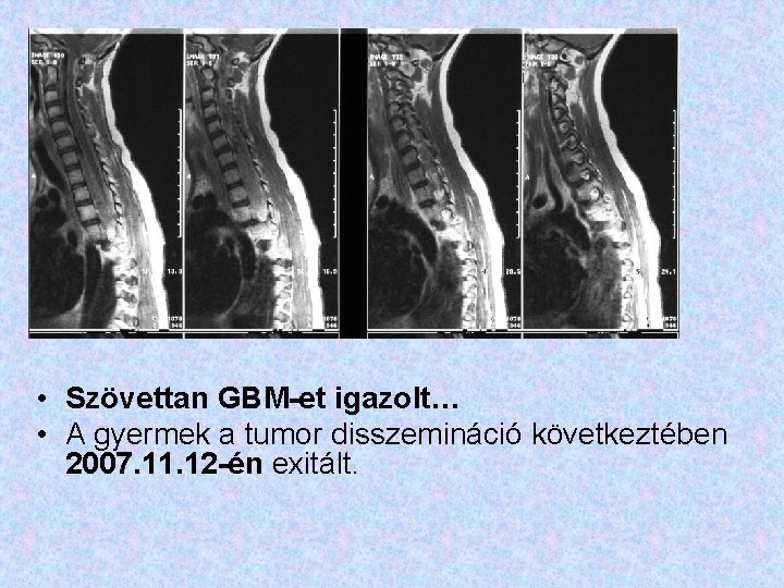  • Szövettan GBM-et igazolt… • A gyermek a tumor disszemináció következtében 2007. 11.