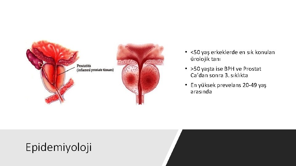  • <50 yaş erkeklerde en sık konulan ürolojik tanı • >50 yaşta ise