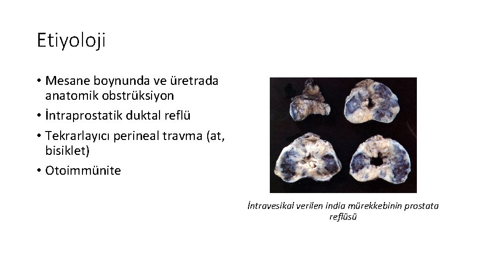 Etiyoloji • Mesane boynunda ve üretrada anatomik obstrüksiyon • İntraprostatik duktal reflü • Tekrarlayıcı