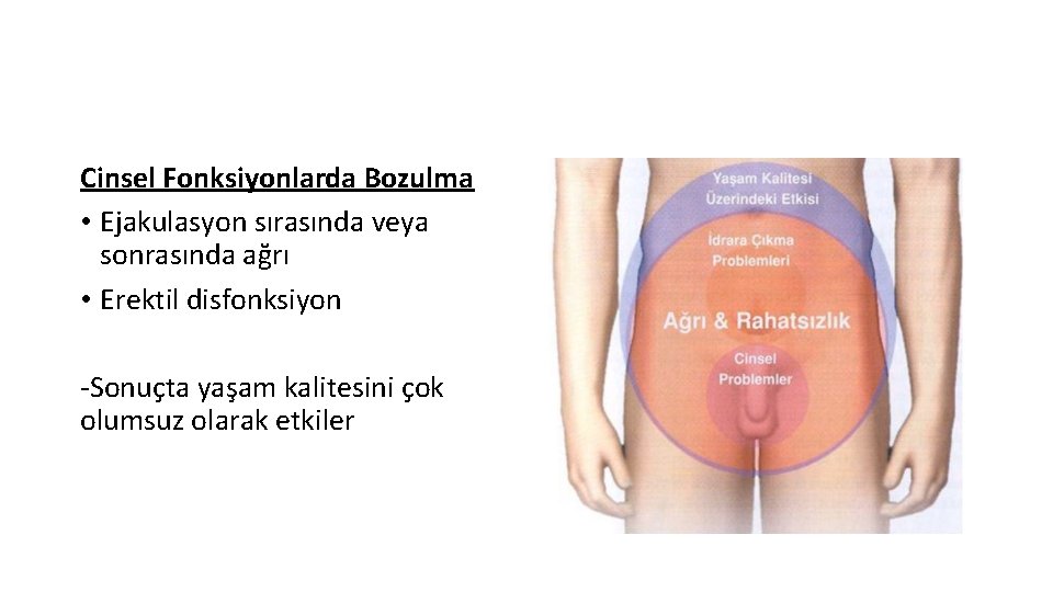 Cinsel Fonksiyonlarda Bozulma • Ejakulasyon sırasında veya sonrasında ağrı • Erektil disfonksiyon -Sonuçta yaşam