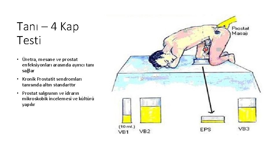 Tanı – 4 Kap Testi • Üretra, mesane ve prostat enfeksiyonları arasında ayırıcı tanı