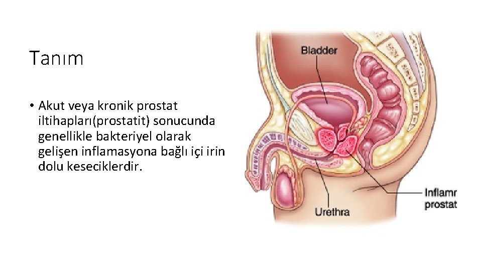 Tanım • Akut veya kronik prostat iltihapları(prostatit) sonucunda genellikle bakteriyel olarak gelişen inflamasyona bağlı