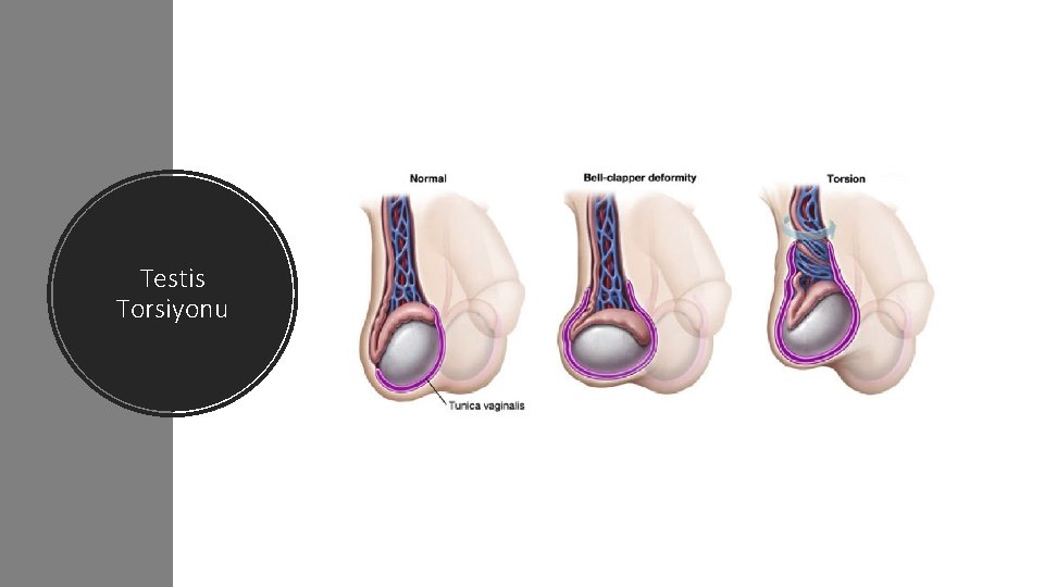 Testis Torsiyonu 