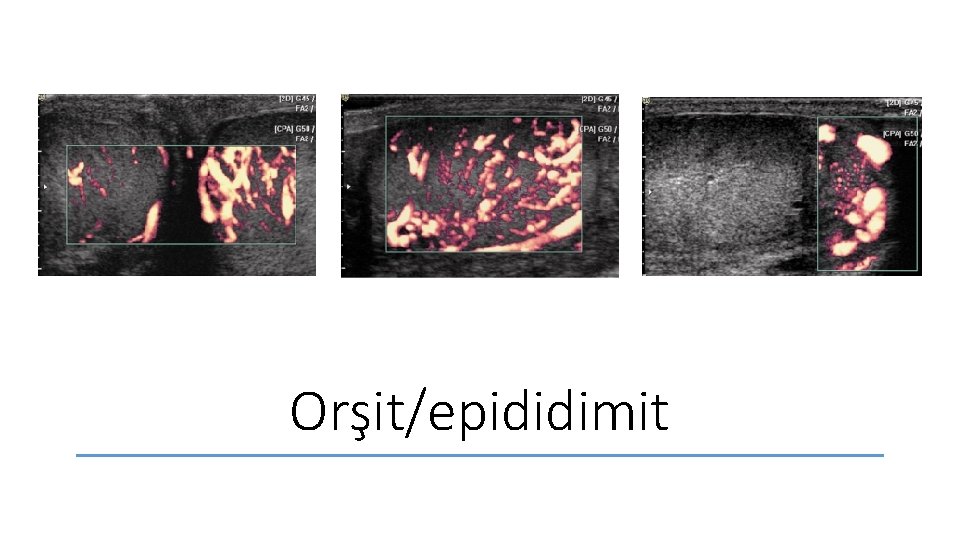 Orşit/epididimit 