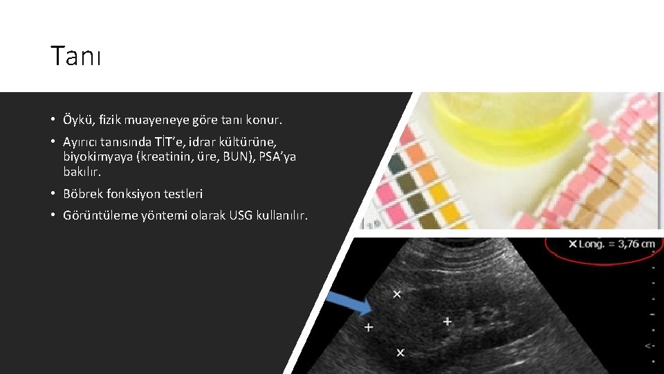 Tanı • Öykü, fizik muayeneye göre tanı konur. • Ayırıcı tanısında TİT’e, idrar kültürüne,