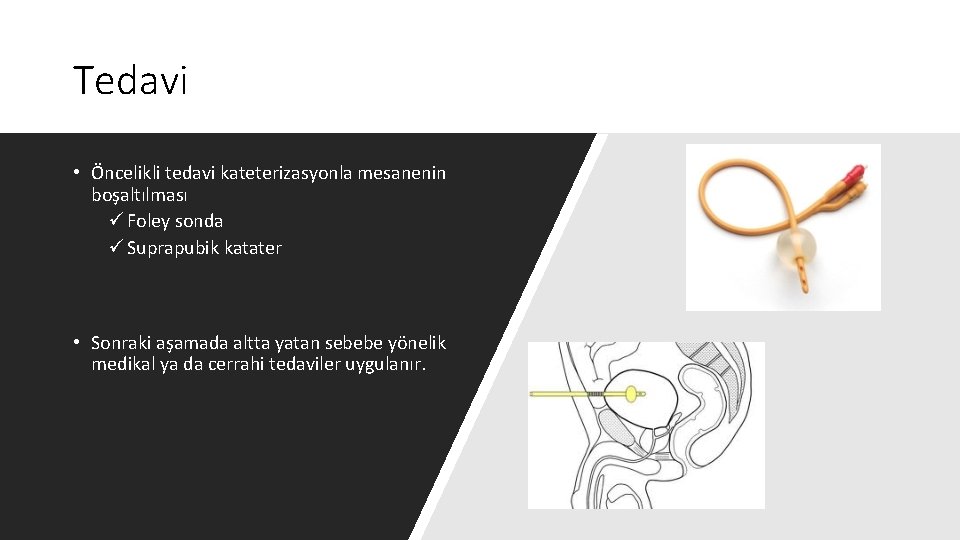 Tedavi • Öncelikli tedavi kateterizasyonla mesanenin boşaltılması ü Foley sonda ü Suprapubik katater •