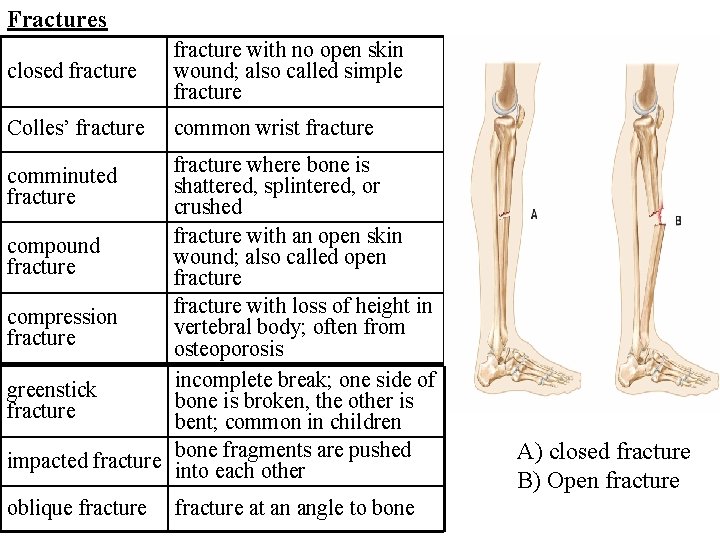 Fractures closed fracture with no open skin wound; also called simple fracture Colles’ fracture