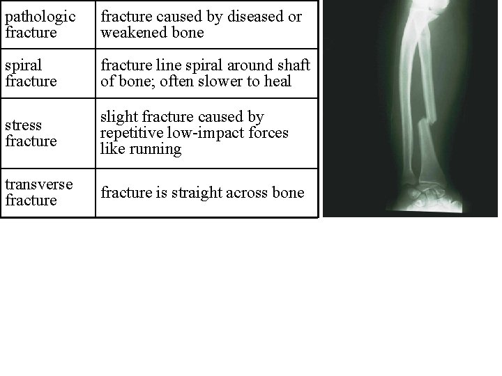pathologic fracture caused by diseased or weakened bone spiral fracture line spiral around shaft