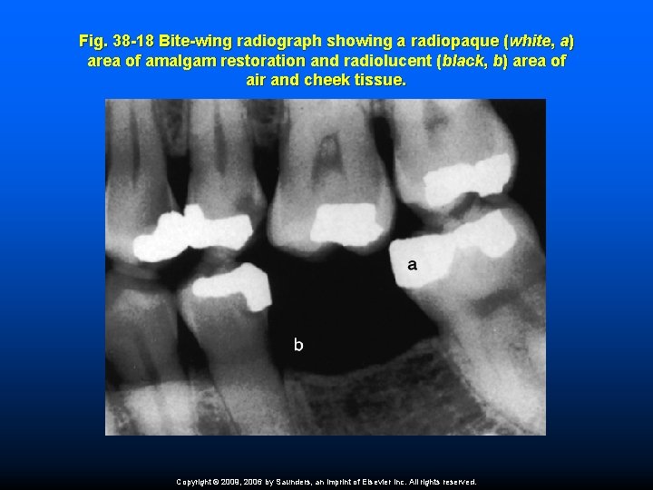 Fig. 38 -18 Bite-wing radiograph showing a radiopaque (white, a) area of amalgam restoration