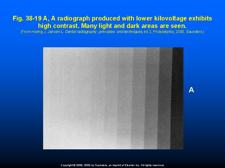 Fig. 38 -19 A, A radiograph produced with lower kilovoltage exhibits high contrast. Many