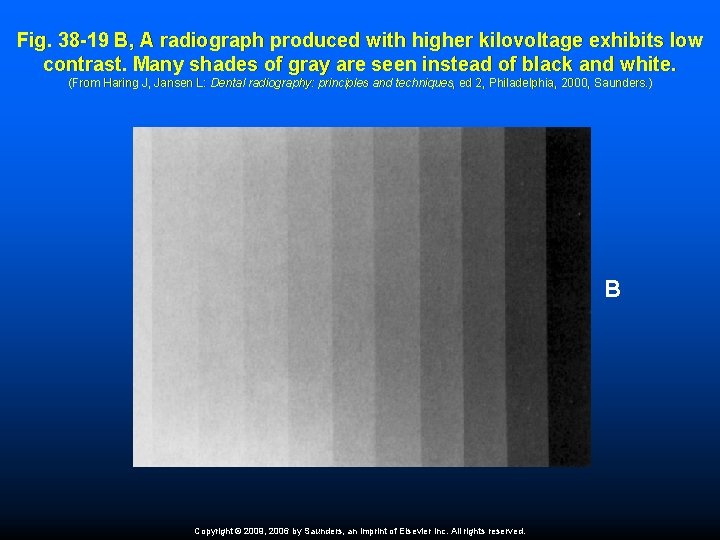 Fig. 38 -19 B, A radiograph produced with higher kilovoltage exhibits low contrast. Many