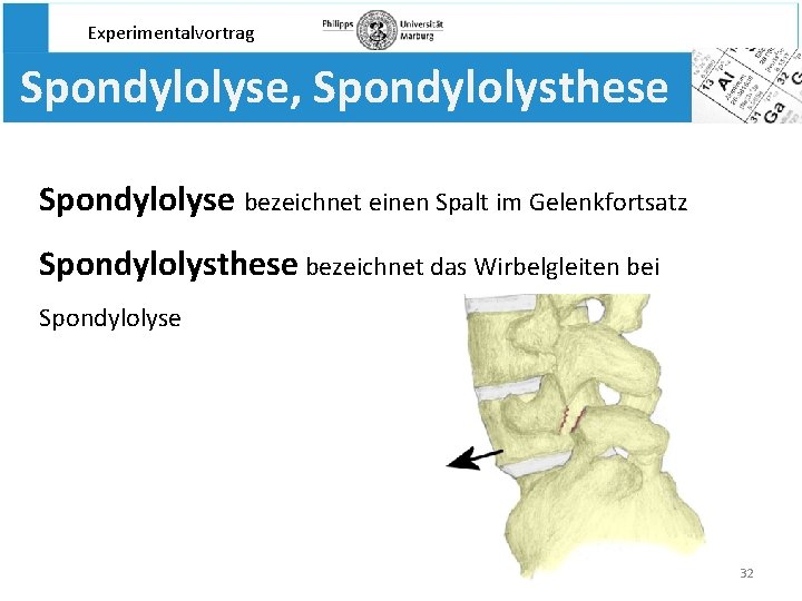 Experimentalvortrag Spondylolyse, Spondylolysthese Spondylolyse bezeichnet einen Spalt im Gelenkfortsatz Spondylolysthese bezeichnet das Wirbelgleiten bei