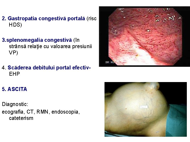 2. Gastropatia congestivă portală (risc HDS) 3. splenomegalia congestivă (în strânsă relaţie cu valoarea